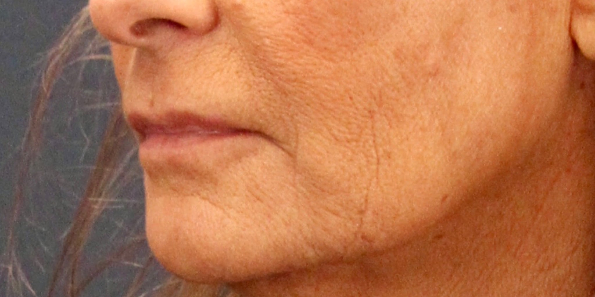 Before Image: Lip Lift - left-front-oblique