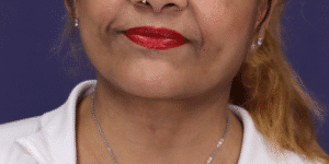 After Image: Facelift, Deep Plane Neck Lift with Anterior Platysmaplasty with Submental Liposuction
