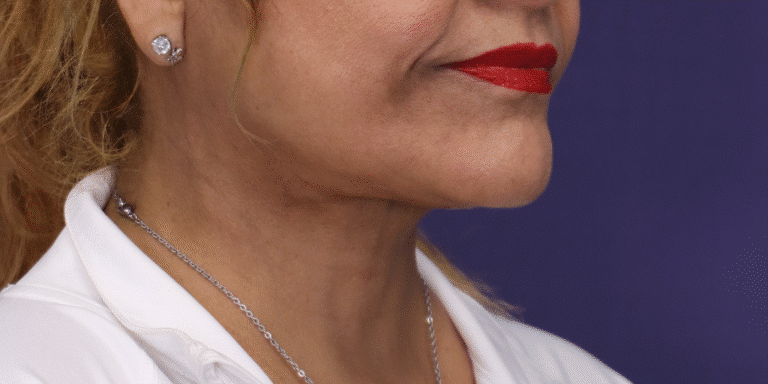 After Image: Facelift, Deep Plane Neck Lift with Anterior Platysmaplasty with Submental Liposuction - right-front-oblique