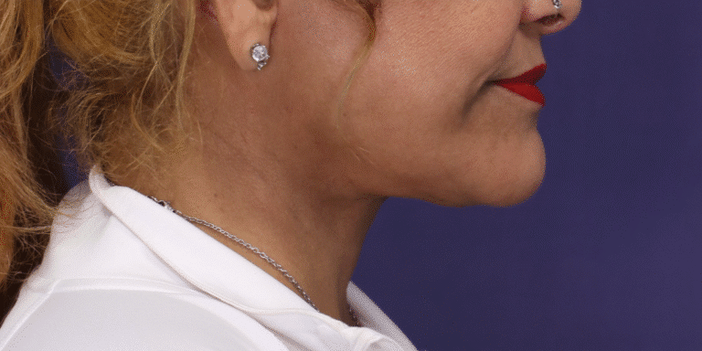 After Image: Facelift, Deep Plane Neck Lift with Anterior Platysmaplasty with Submental Liposuction - right-side