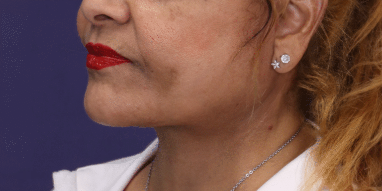 After Image: Facelift, Deep Plane Neck Lift with Anterior Platysmaplasty with Submental Liposuction - left-front-oblique