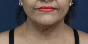 Before Image: Facelift, Deep Plane Neck Lift with Anterior Platysmaplasty with Submental Liposuction