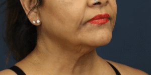 Before Image: Facelift & Extended Deep Plane Neck Lift
