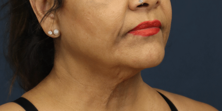 Before Image: Facelift, Deep Plane Neck Lift with Anterior Platysmaplasty with Submental Liposuction - right-front-oblique