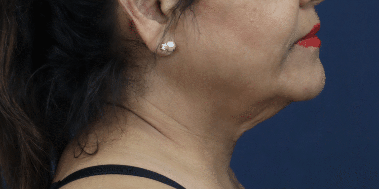 Before Image: Facelift, Deep Plane Neck Lift with Anterior Platysmaplasty with Submental Liposuction - right-side