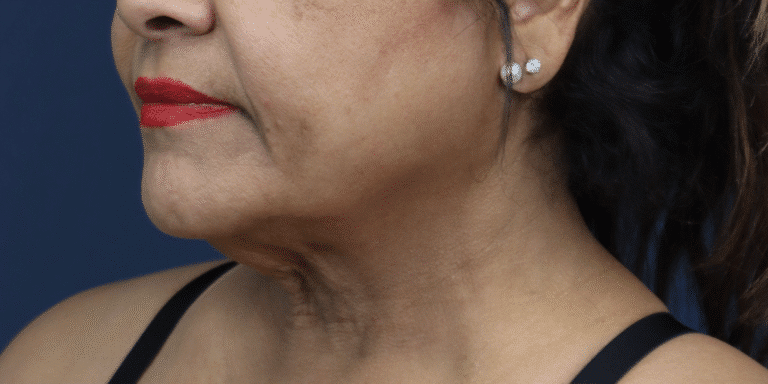Before Image: Facelift, Deep Plane Neck Lift with Anterior Platysmaplasty with Submental Liposuction - left-front-oblique