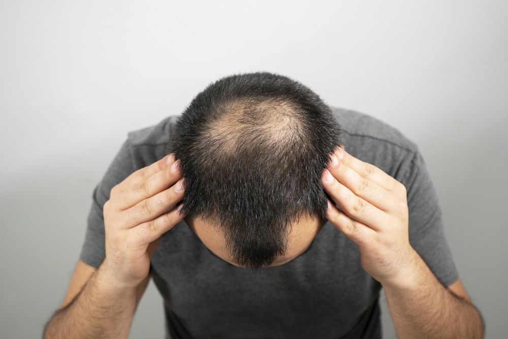 Man showing top of head with male pattern baldness