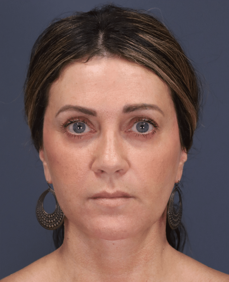 After Image: Deep Plane Face and Neck Lift - front