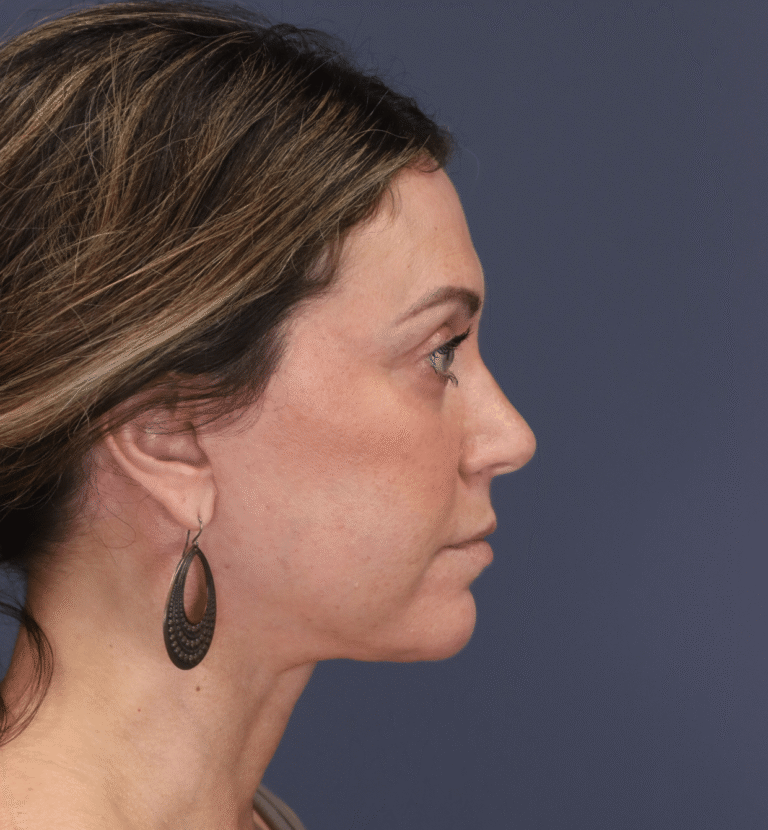 After Image: Deep Plane Face and Neck Lift - right-side