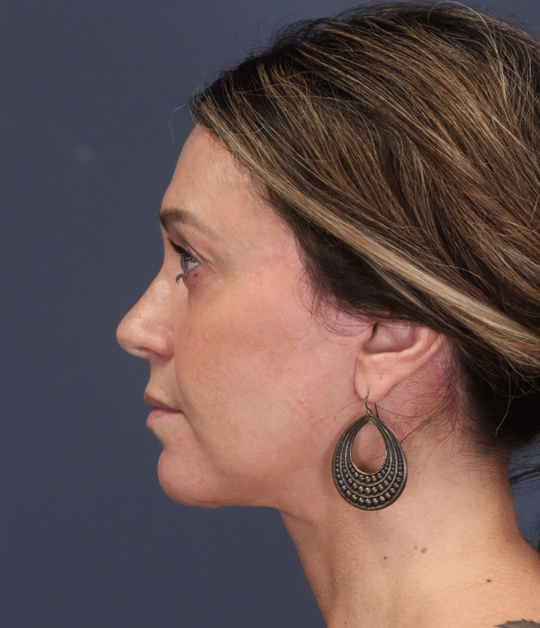 After Image: Deep Plane Face and Neck Lift - left-side