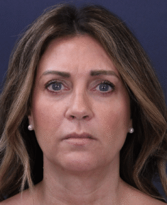 Before Image: Deep Plane Face and Neck Lift