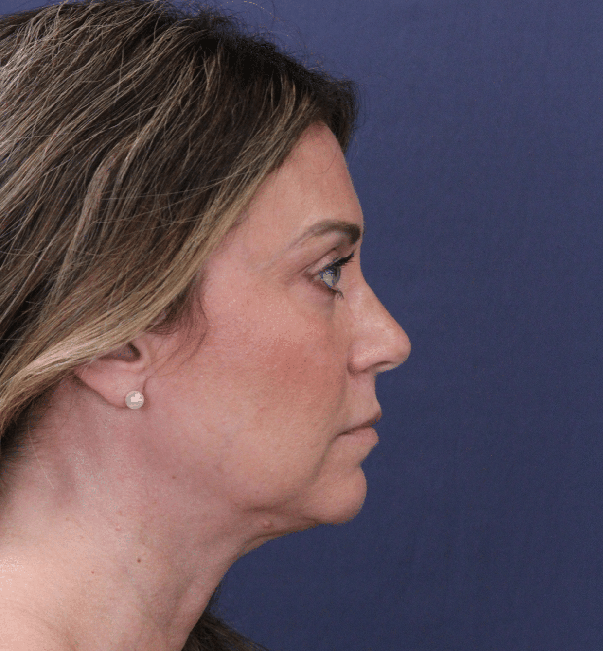 Before Image: Deep Plane Face and Neck Lift - right-side
