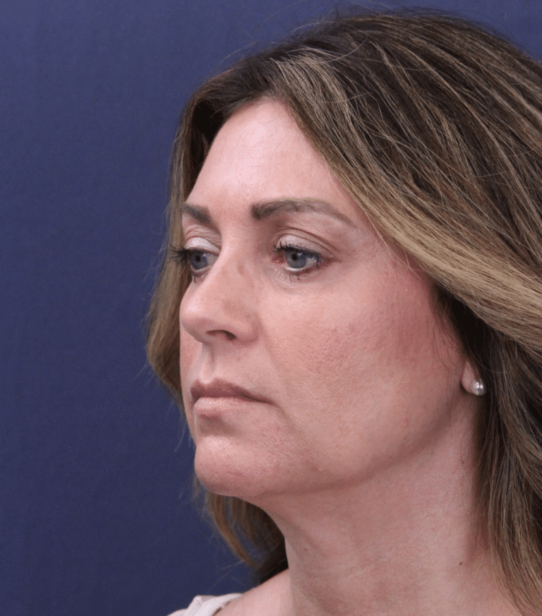 Before Image: Deep Plane Face and Neck Lift - left-front-oblique