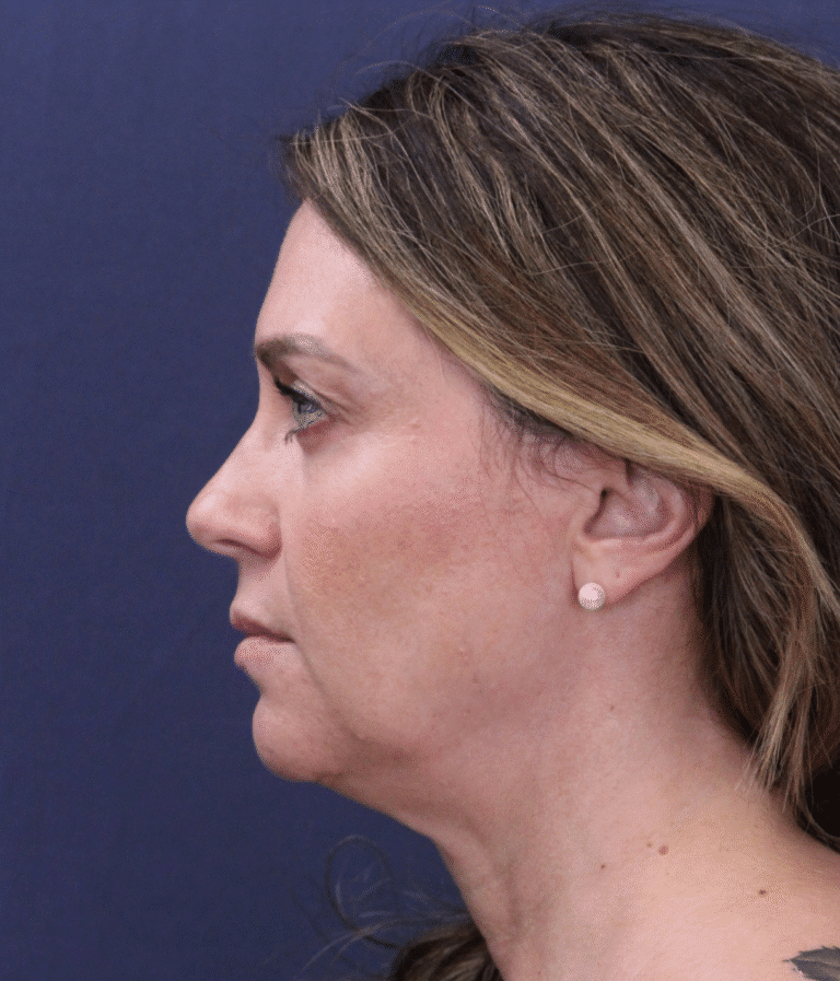 Before Image: Deep Plane Face and Neck Lift - left-side