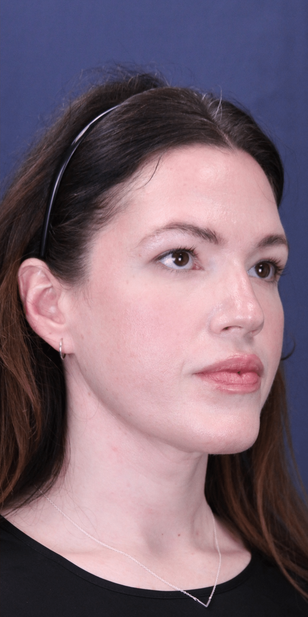 After Image: Lower Eyelid Lift with Fat Grafting & Minimally Invasive Neck Lift - right-front-oblique