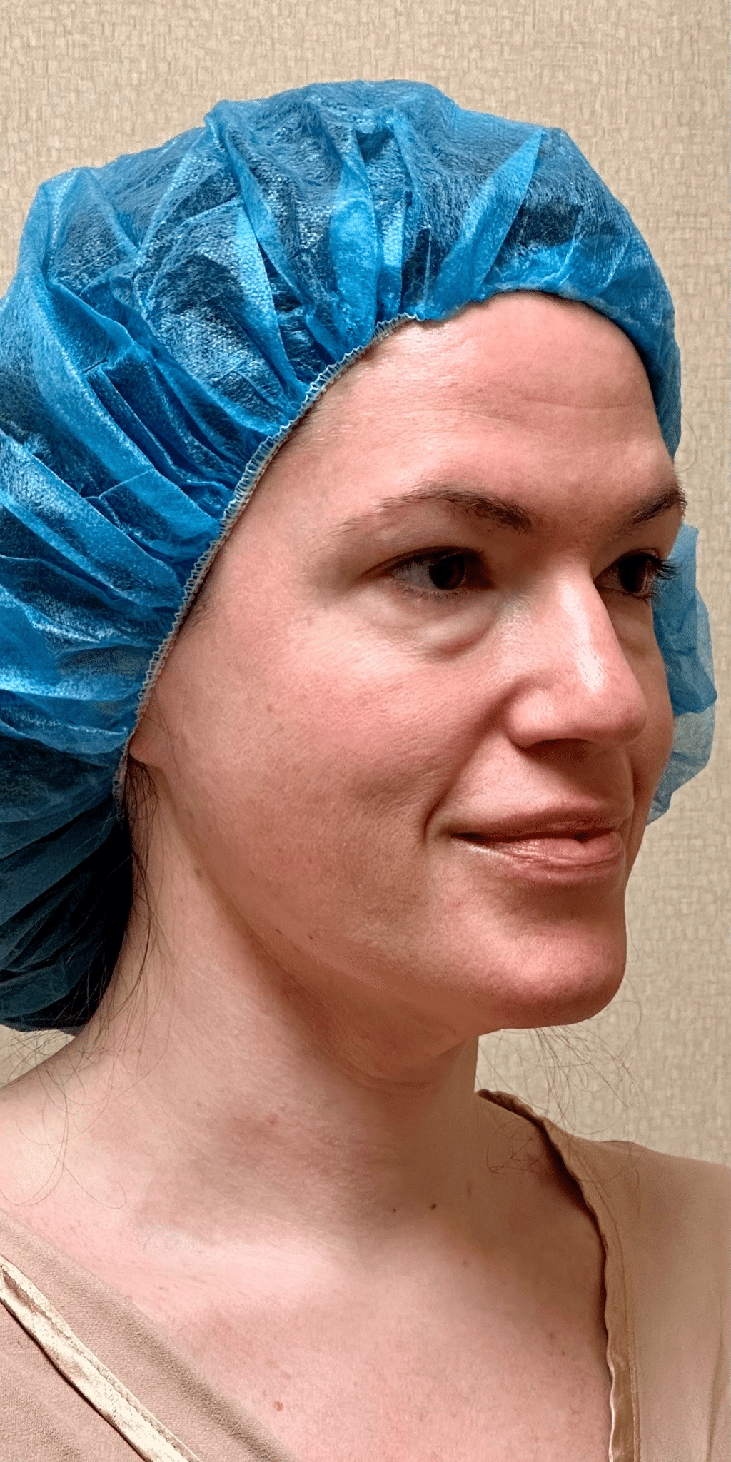 Before Image: Lower Eyelid Lift with Fat Grafting & Minimally Invasive Neck Lift - right-front-oblique