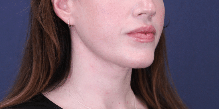 After Image: MyEllevate Neck Lift, Lower Eyelid Lift & Facial Fat Grafting - right-front-oblique