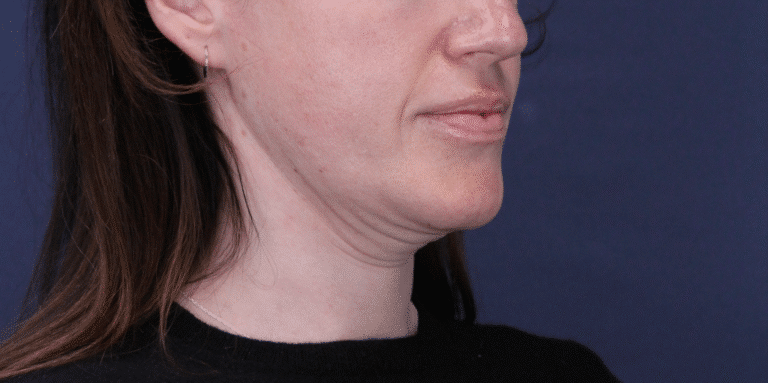 Before Image: MyEllevate Neck Lift, Lower Eyelid Lift & Facial Fat Grafting - right-front-oblique