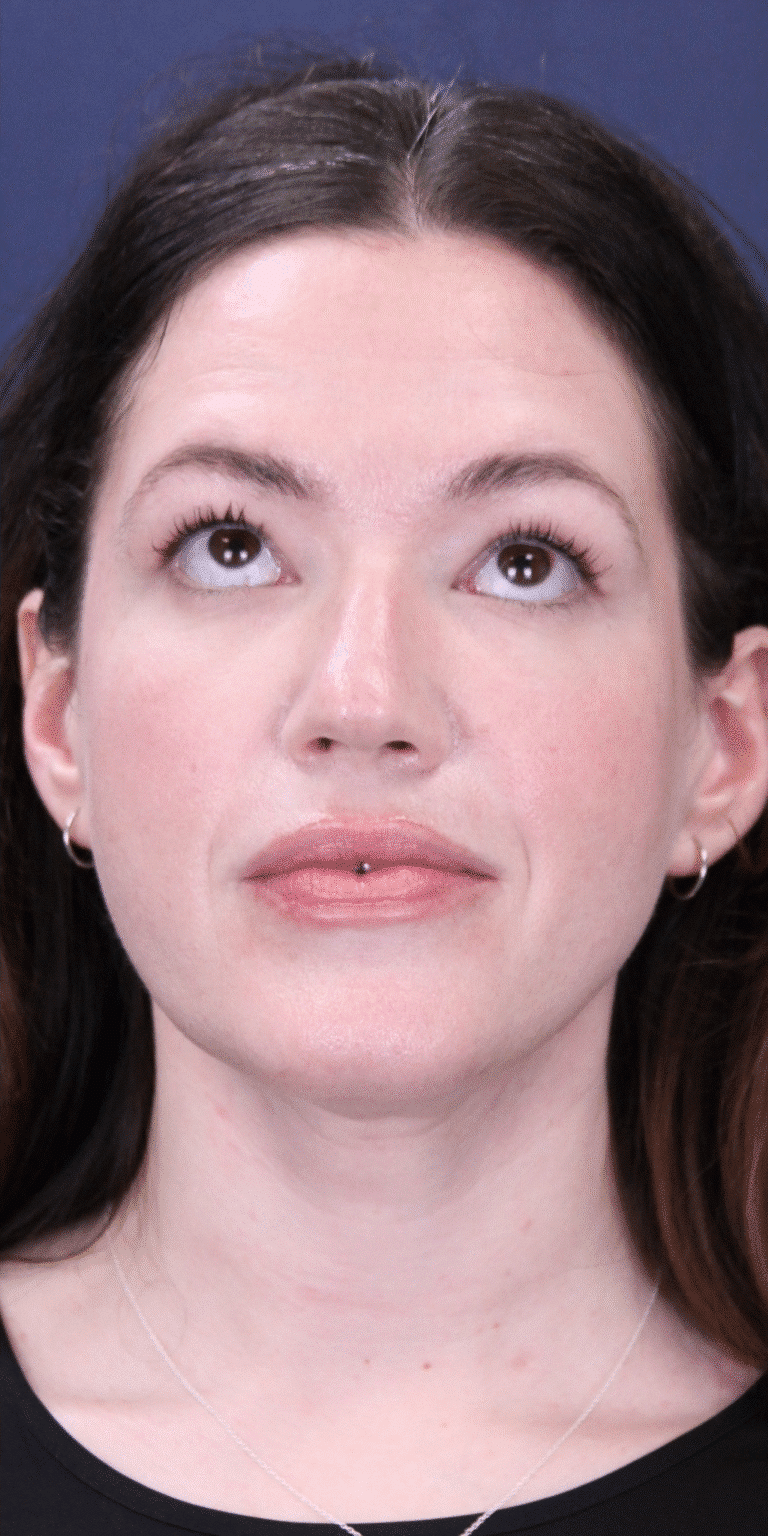 After Image: MyEllevate Neck Lift, Lower Eyelid Lift & Facial Fat Grafting - front