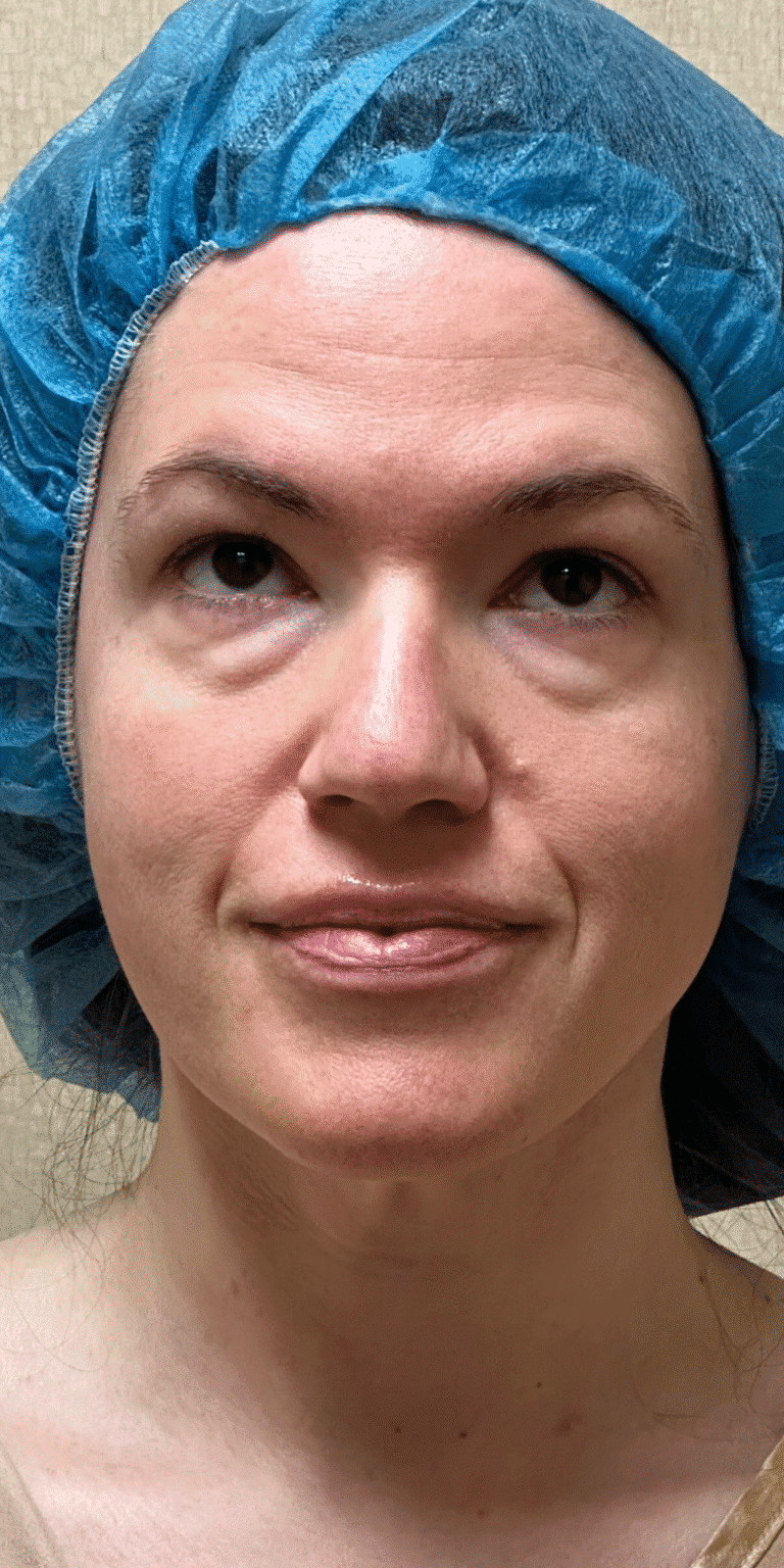 Before Image: MyEllevate Neck Lift, Lower Eyelid Lift & Facial Fat Grafting - front