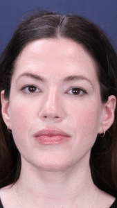 After Image: MyEllevate Neck Lift, Lower Eyelid Lift & Facial Fat Grafting
