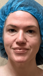 Before Image: MyEllevate Neck Lift, Lower Eyelid Lift & Facial Fat Grafting