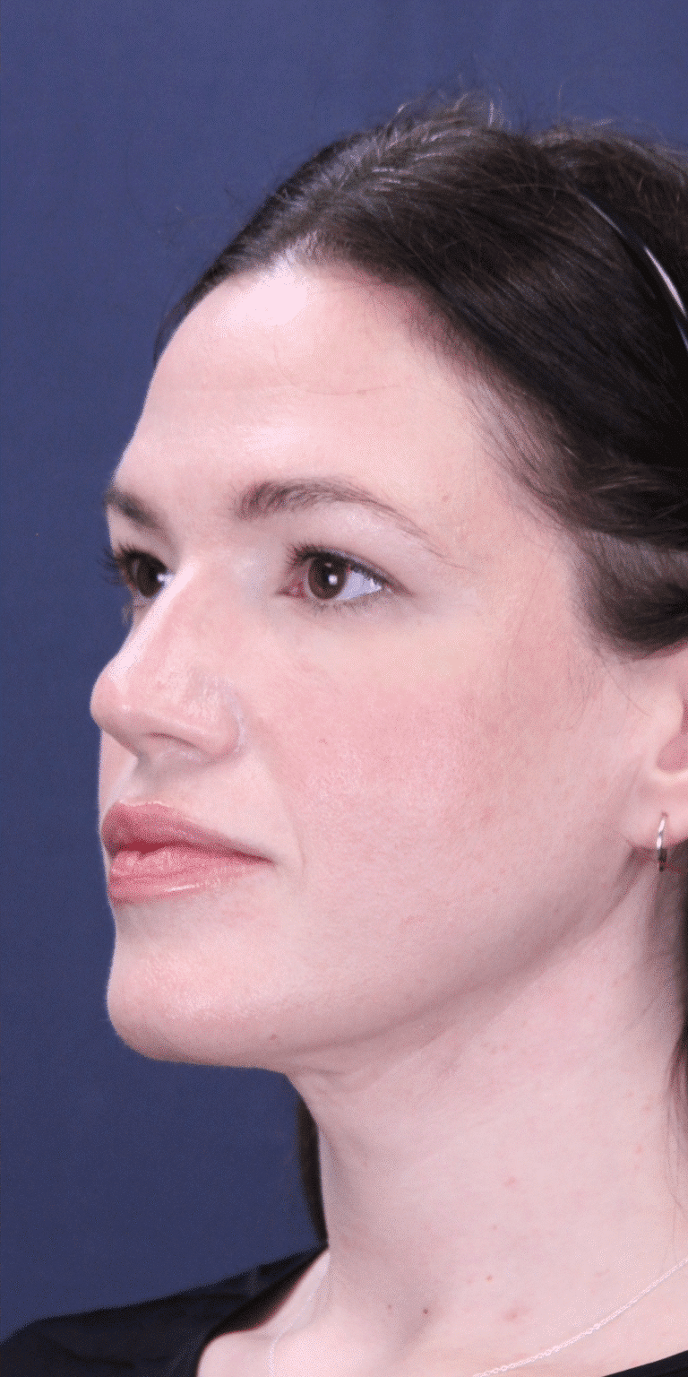 After Image: MyEllevate Neck Lift, Lower Eyelid Lift & Facial Fat Grafting - left-front-oblique