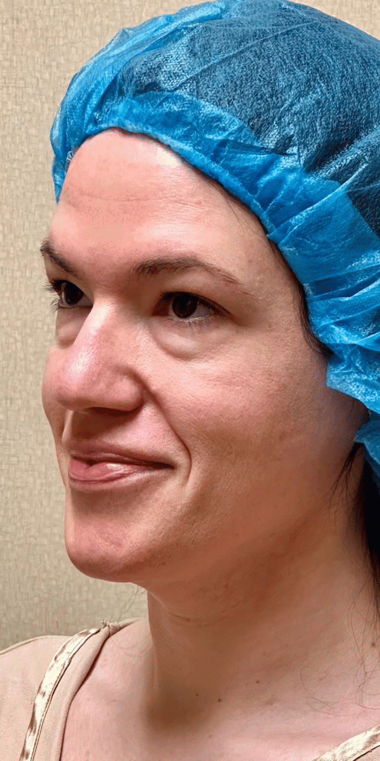 Before Image: MyEllevate Neck Lift, Lower Eyelid Lift & Facial Fat Grafting - left-front-oblique