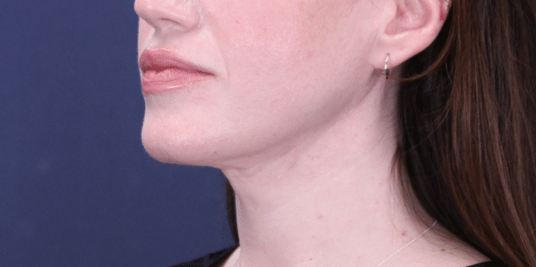 After Image: MyEllevate Neck Lift, Lower Eyelid Lift & Facial Fat Grafting - left-front-oblique