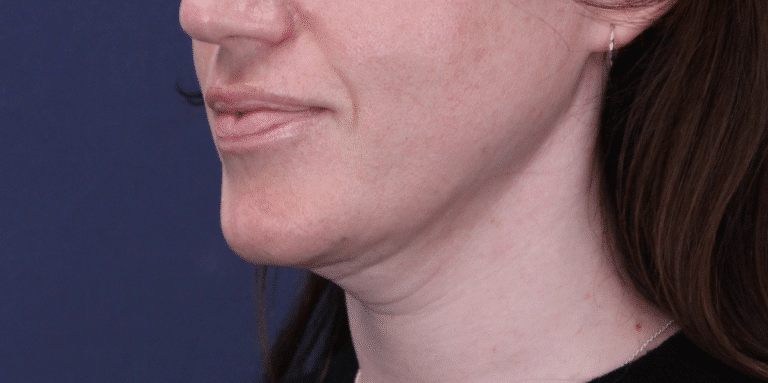 Before Image: MyEllevate Neck Lift, Lower Eyelid Lift & Facial Fat Grafting - left-front-oblique