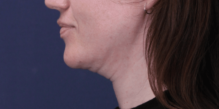 Before Image: MyEllevate Neck Lift, Lower Eyelid Lift & Facial Fat Grafting - left-side