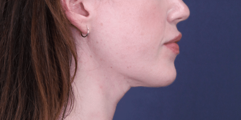 After Image: MyEllevate Neck Lift, Lower Eyelid Lift & Facial Fat Grafting - right-side