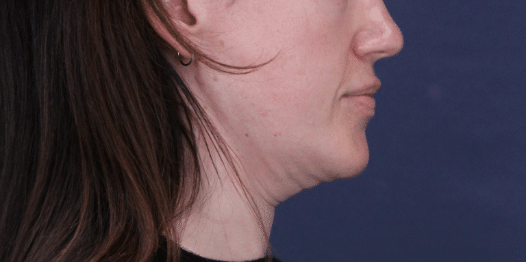 Before Image: MyEllevate Neck Lift, Lower Eyelid Lift & Facial Fat Grafting - right-side