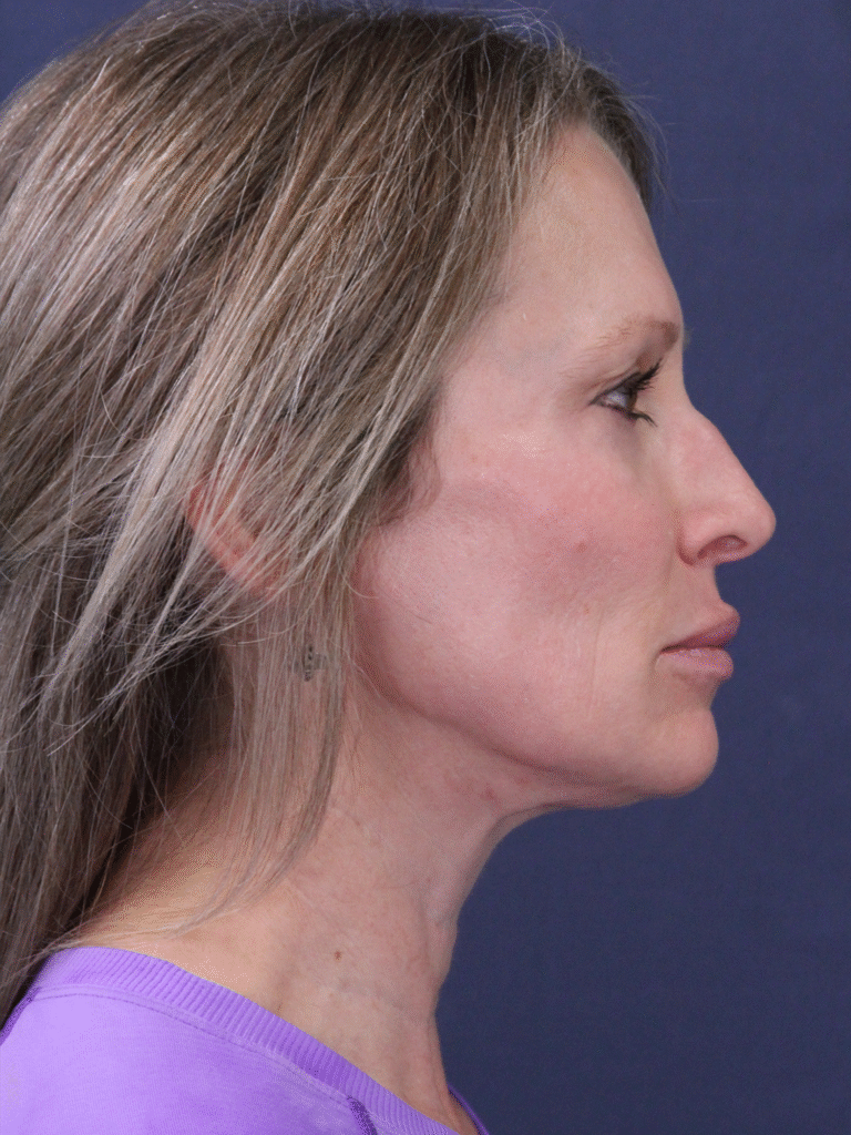 After Image: MyEllevate MInimally Invasive Neck Lift - right-side