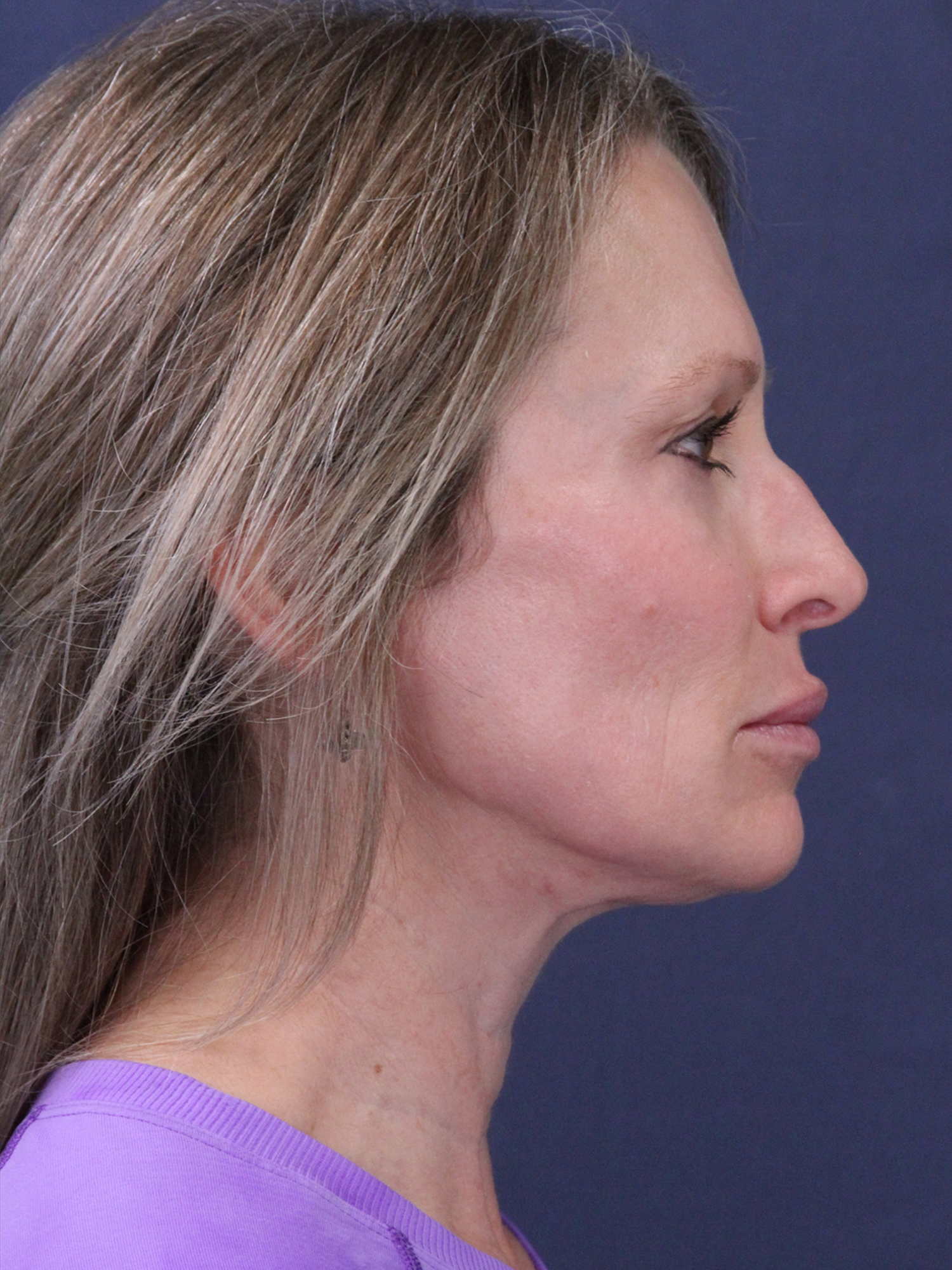 After Image: MInimally Invasive Neck Lift - right-side