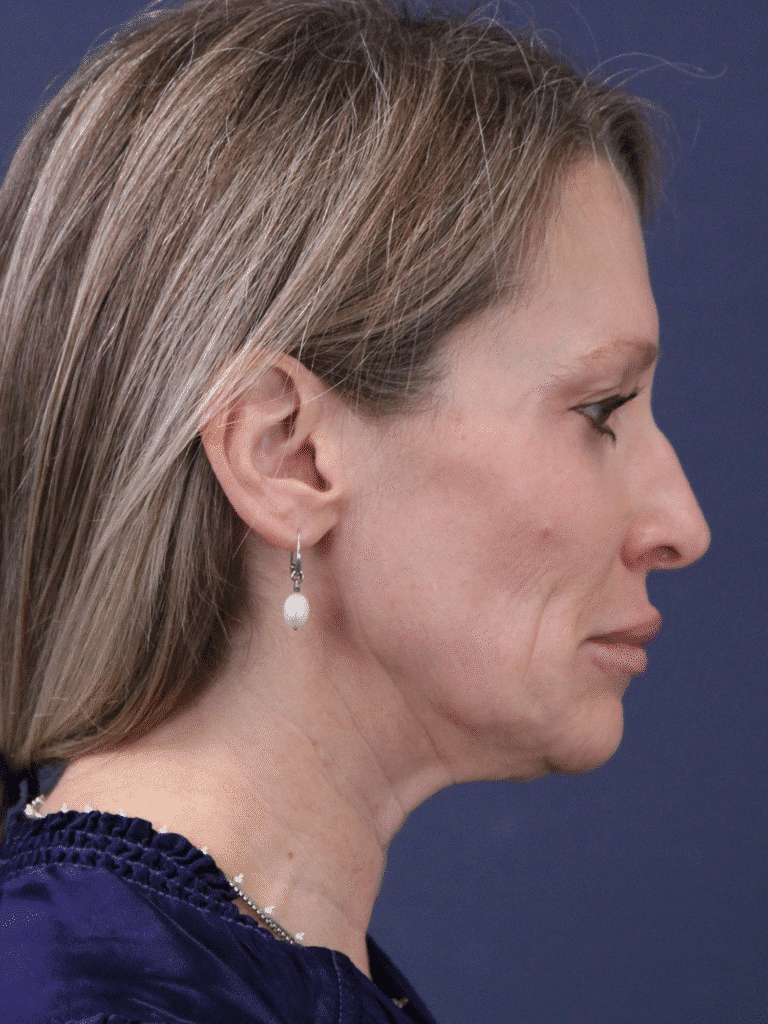 Before Image: MyEllevate MInimally Invasive Neck Lift - right-side