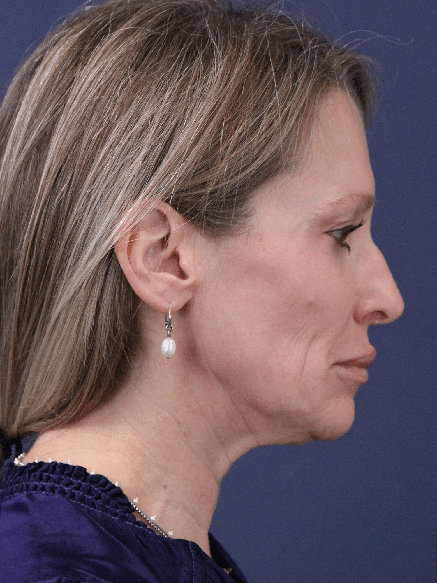 Before Image: MInimally Invasive Neck Lift - right-side