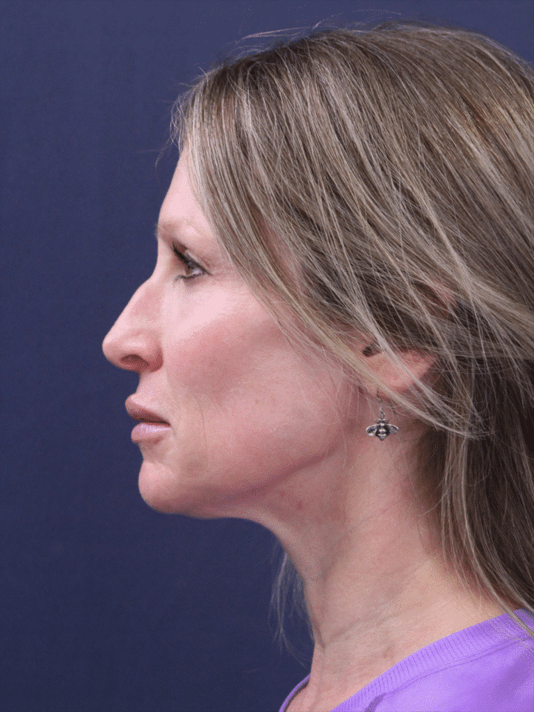 After Image: MyEllevate MInimally Invasive Neck Lift - left-side