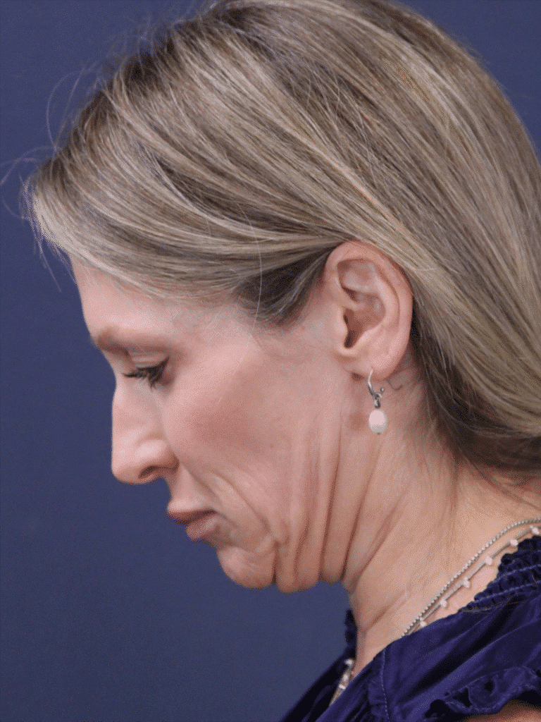 Before Image: MyEllevate MInimally Invasive Neck Lift - left-side