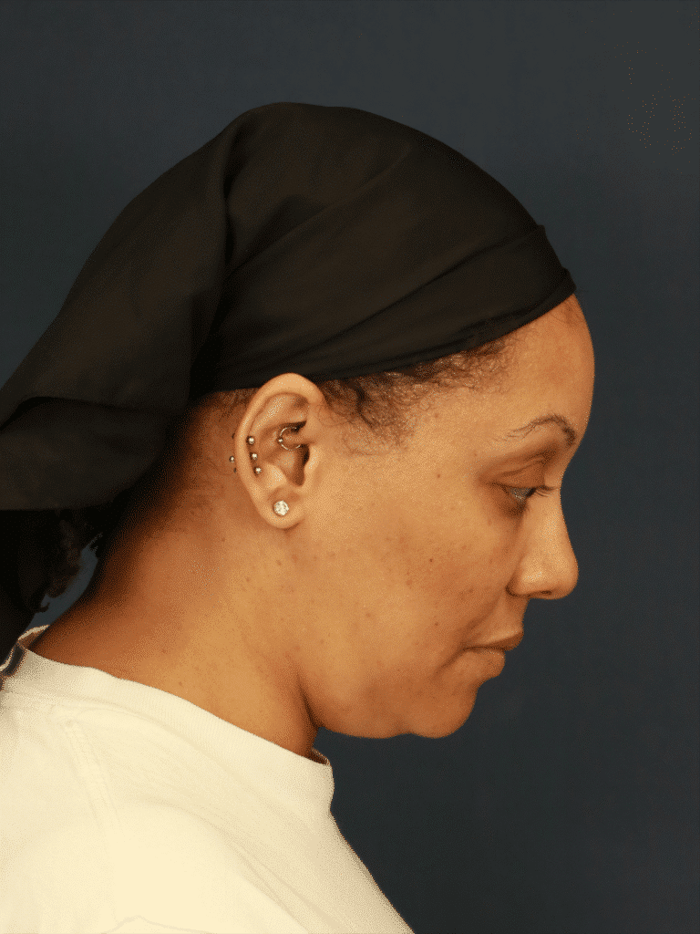 After Image: Neck Liposuction -