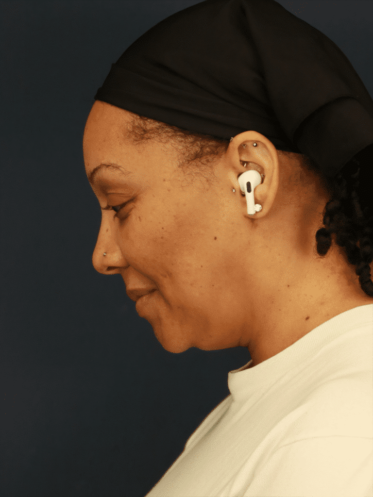 After Image: Neck Liposuction - left-side