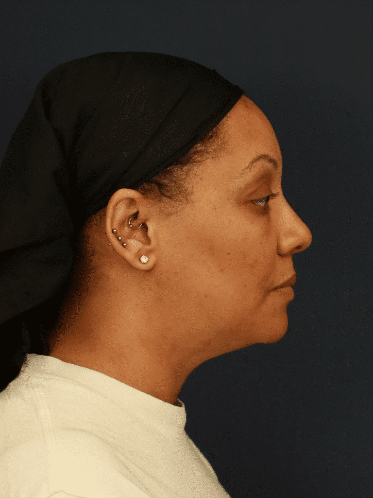 After Image: Neck Liposuction - right-side