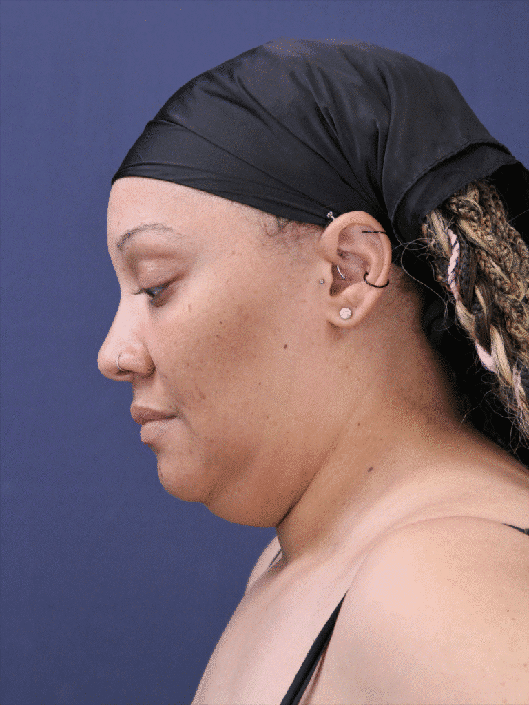 Before Image: Neck Liposuction - left-side