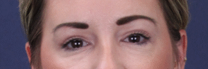 After Image: Upper Blepharoplasty