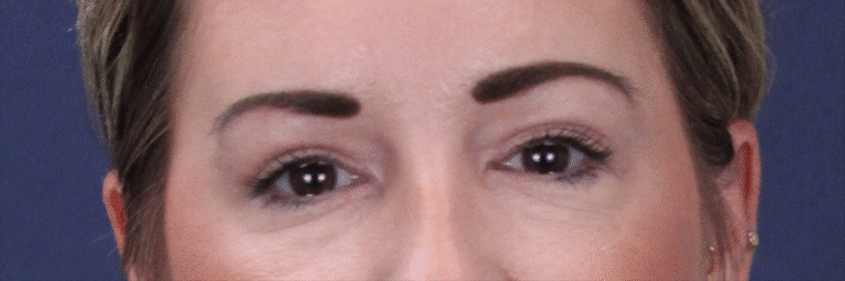 After Image: Upper Blepharoplasty - front