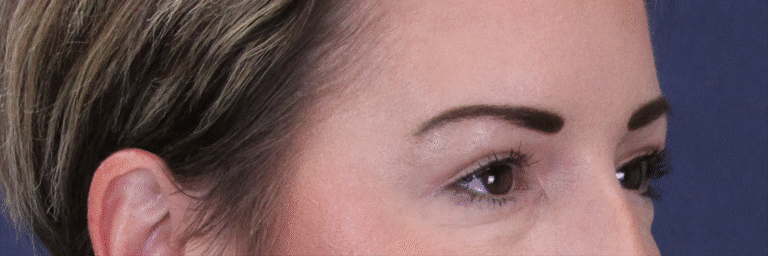 After Image: Upper Blepharoplasty - right-front-oblique