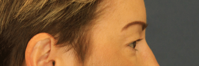 Before Image: Upper Blepharoplasty - right-side