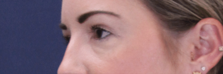 After Image: Upper Blepharoplasty - left-front-oblique