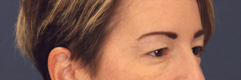 Before Image: Upper Blepharoplasty - right-front-oblique