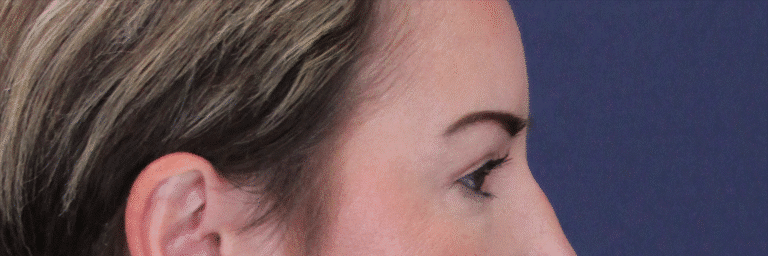 After Image: Upper Blepharoplasty - right-side